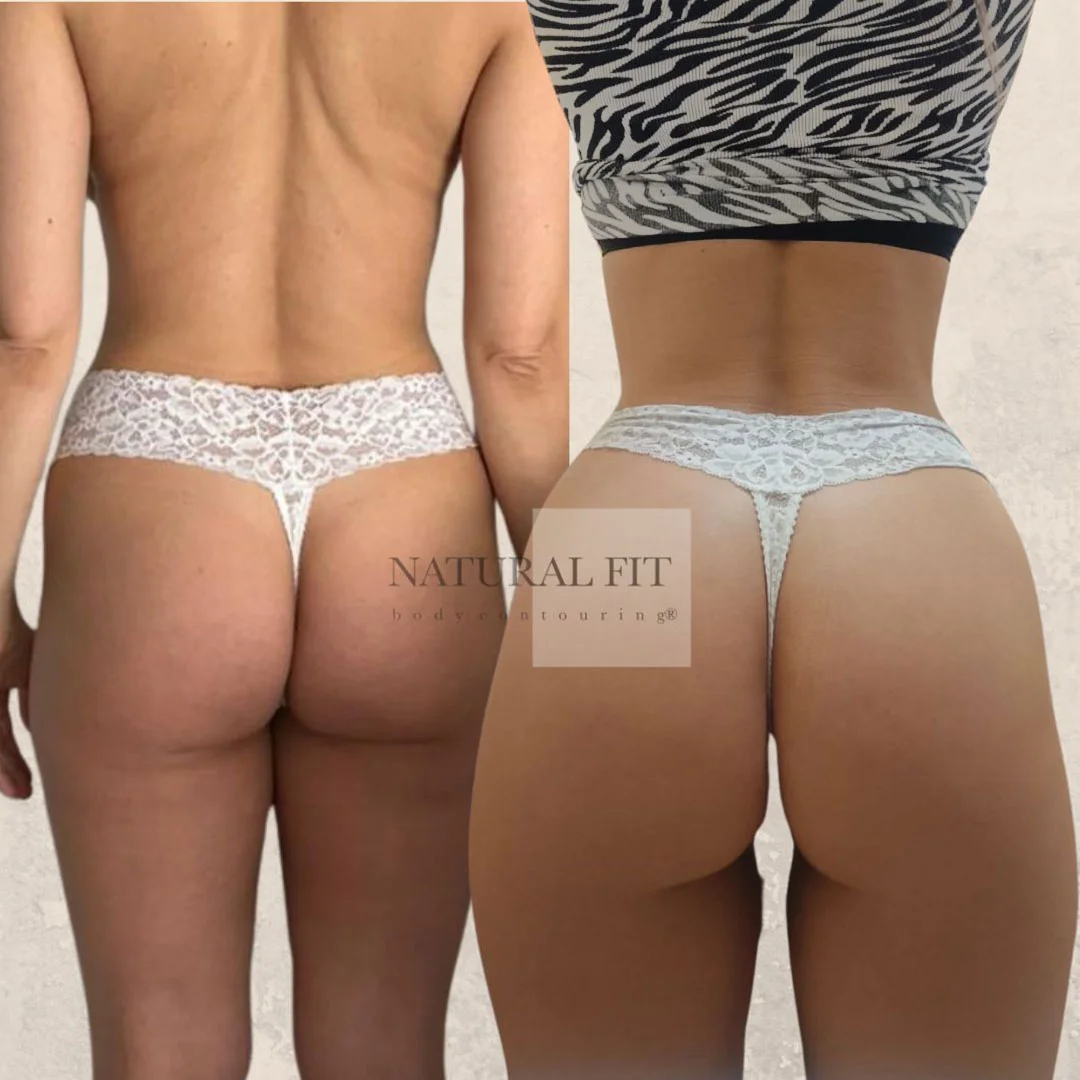 Antes y después Brazilian Butt Lift Alba - NATURAL FIT Body Contouring® Barcelona