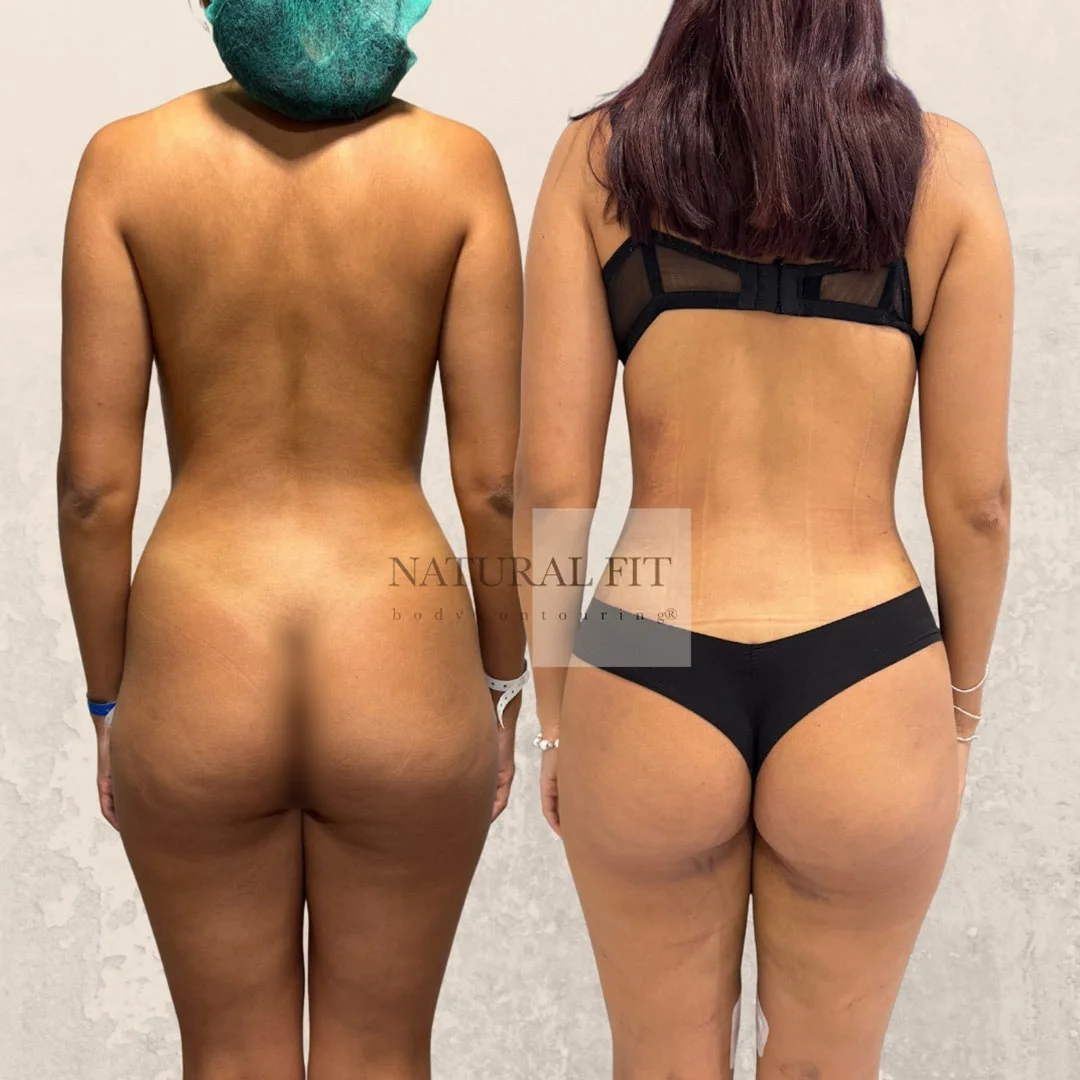 Despu&eacute;s Reducci&oacute;n Gl&uacute;tea