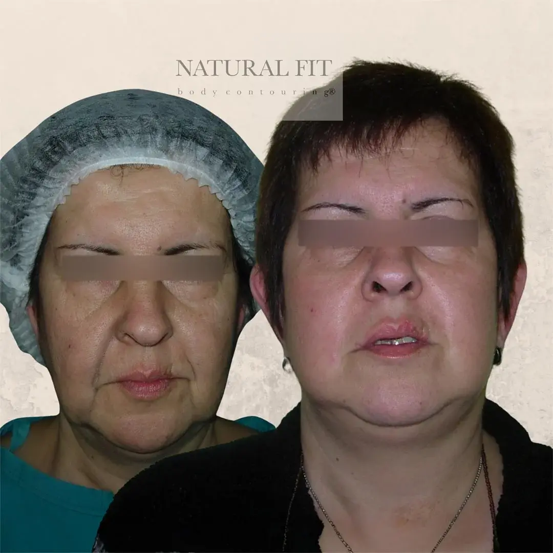 Resultado lifting facial Adriana, Tarragona - Dr. Mart&iacute;n Gast&oacute;n