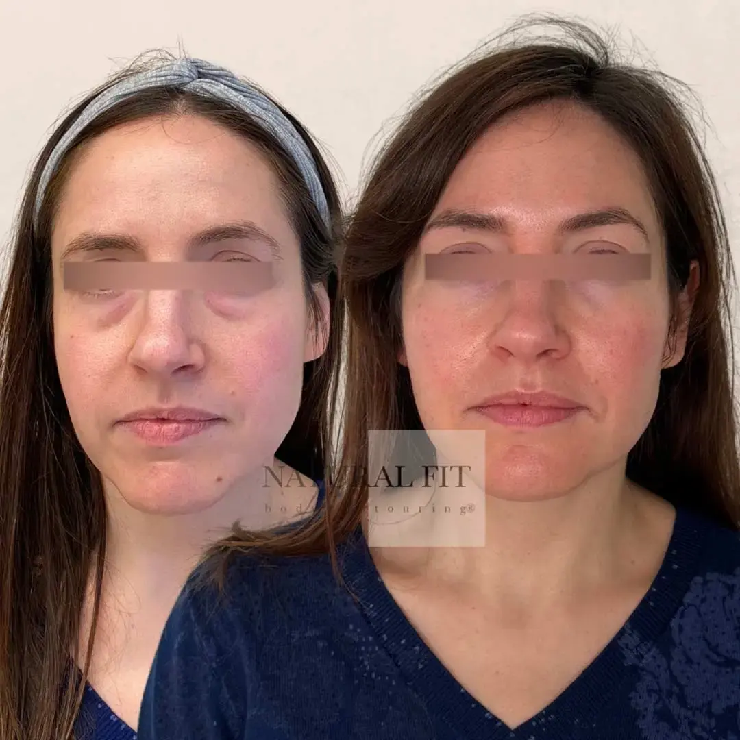 Resultado blefaroplastia mujer Barcelona - Dr. Mart&iacute;n Gast&oacute;n