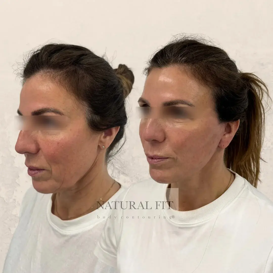Resultado lifting facial Heidi, Girona - Dr. Mart&iacute;n Gast&oacute;n