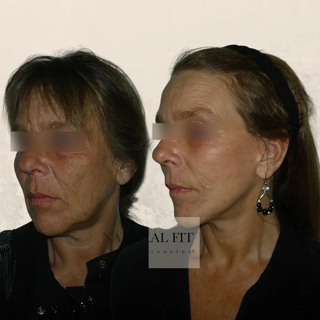 Resultado lifting facial Julia, Manresa - Dr. Mart&iacute;n Gast&oacute;n