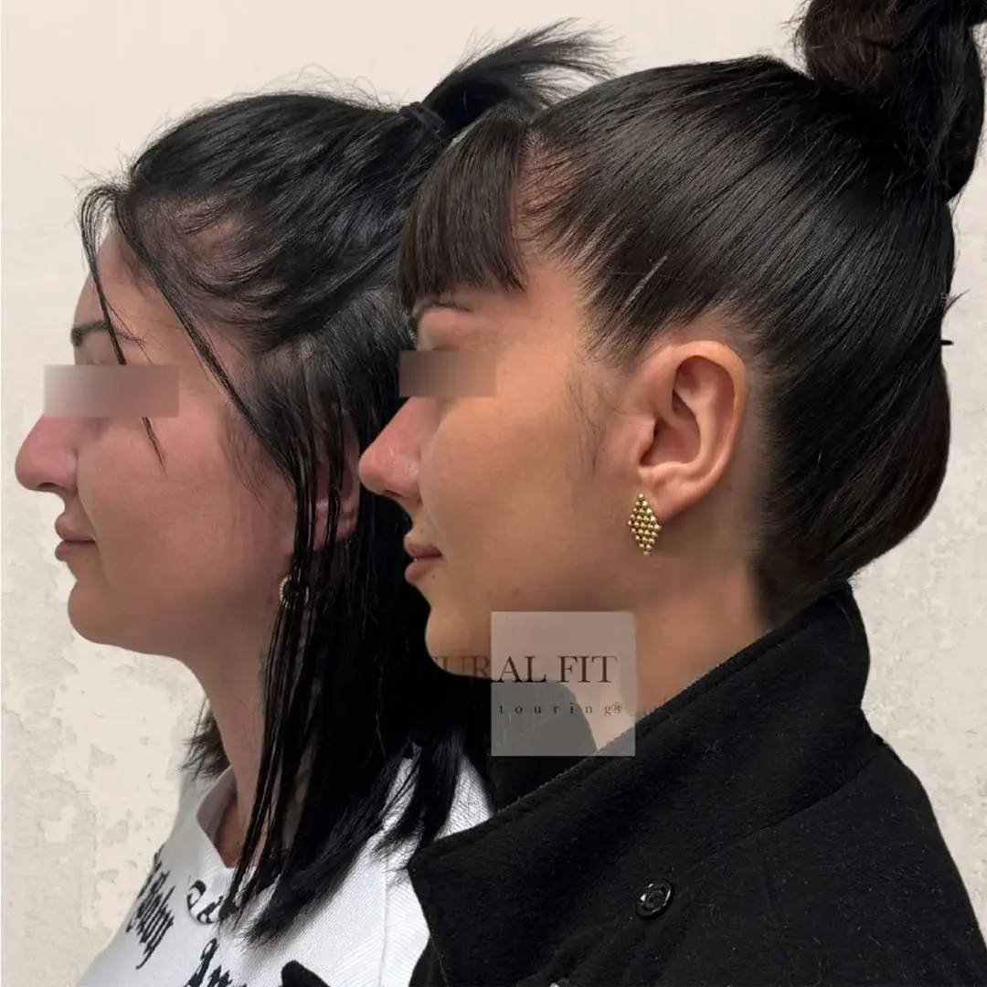 Despu&eacute;s Rinoplastia Barcelona — vista lateral