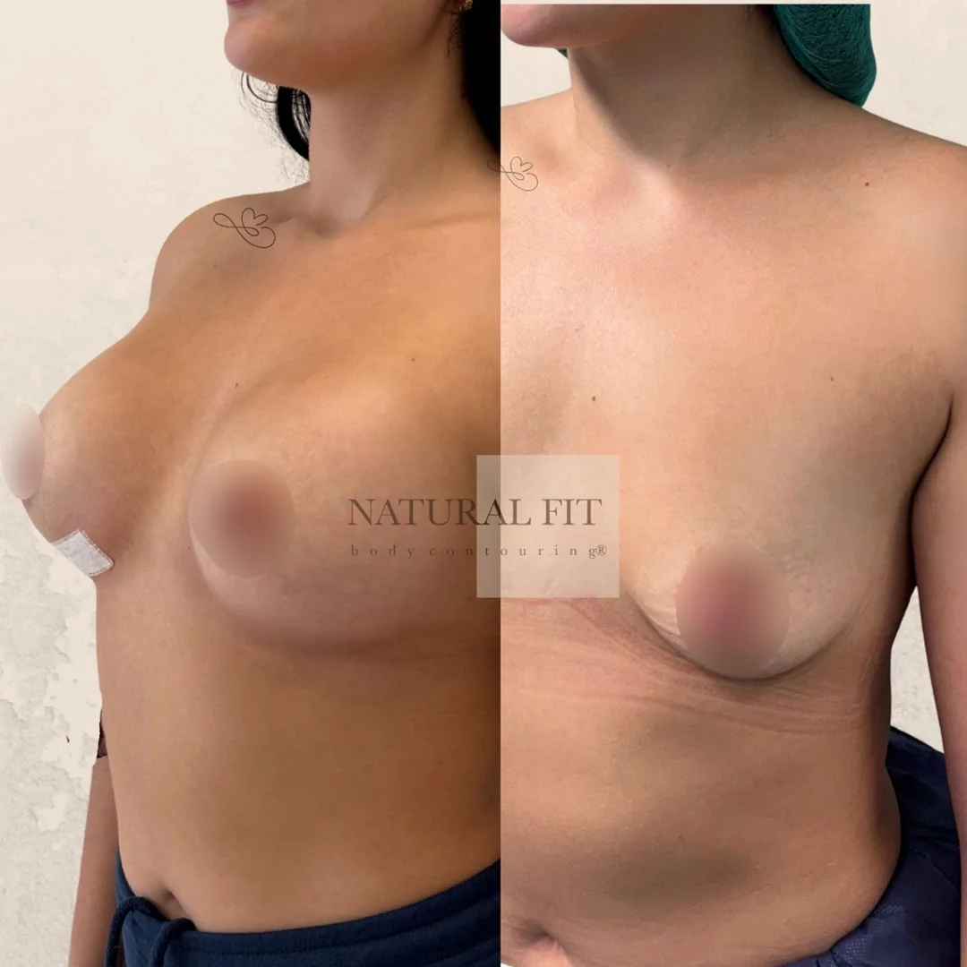 Resultado real aumento pecho Barcelona - NATURAL FIT Body Contouring®