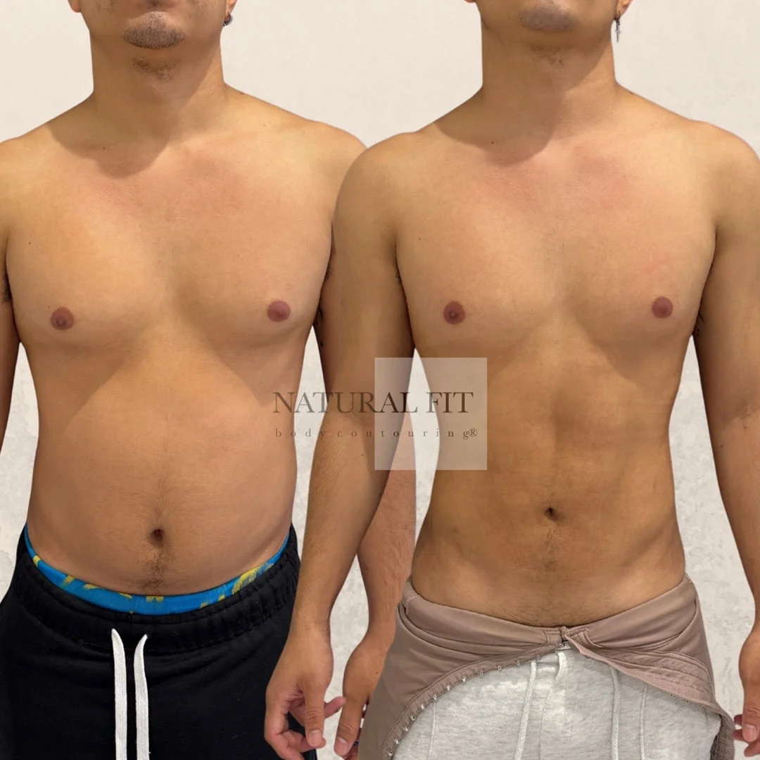 Resultado liposucción abdominal Marcos, 22 años, Barcelona - Dr. Martín Gastón
