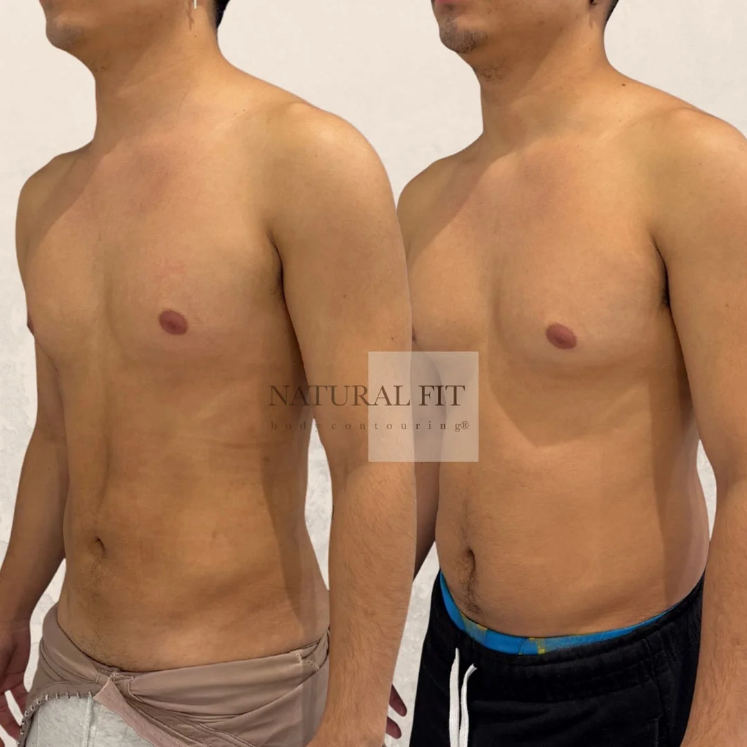 Marcos ginecomastia resultado 2