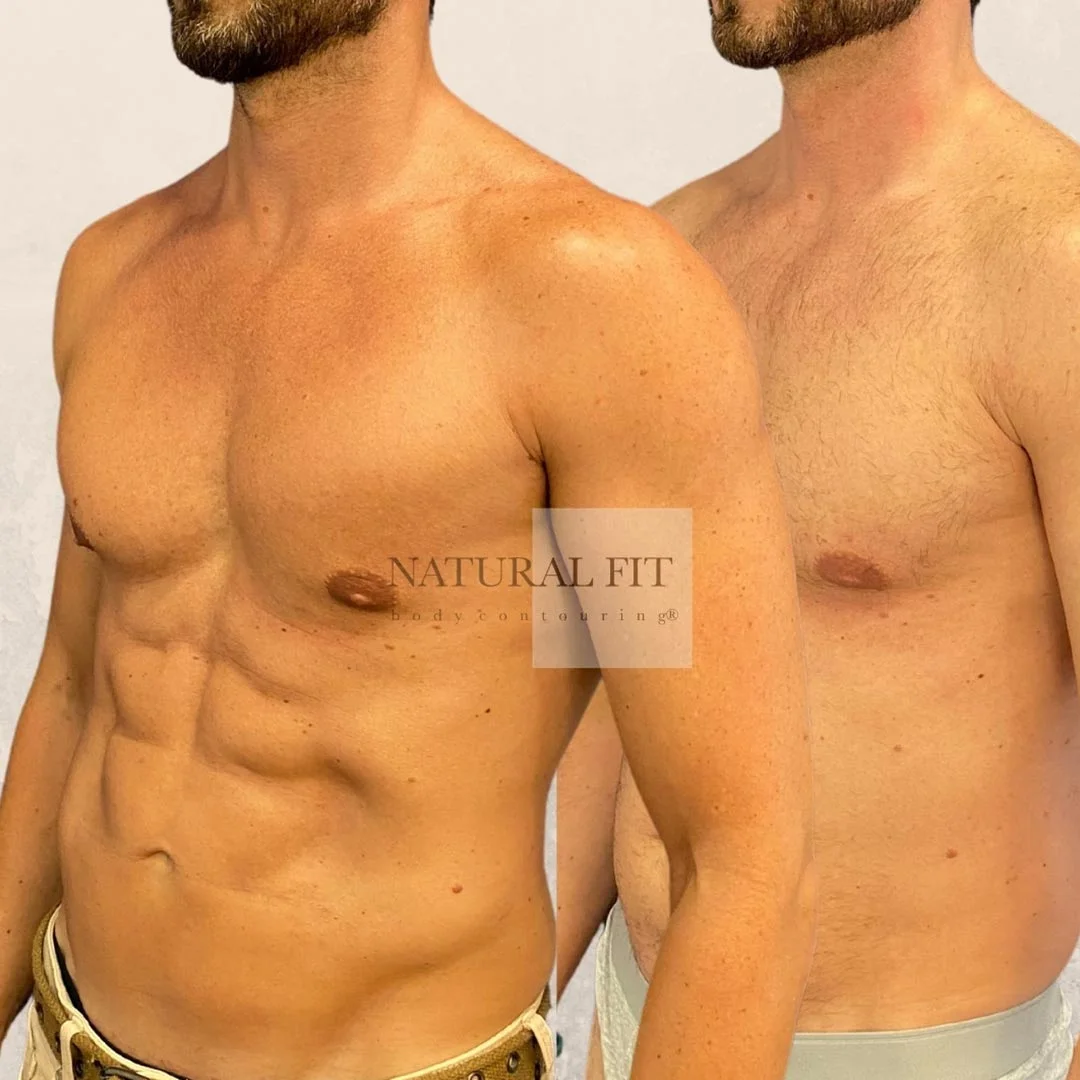 Antes y después lipovaser alta definición Antonio 35 años - NATURAL FIT Body Contouring® Barcelona