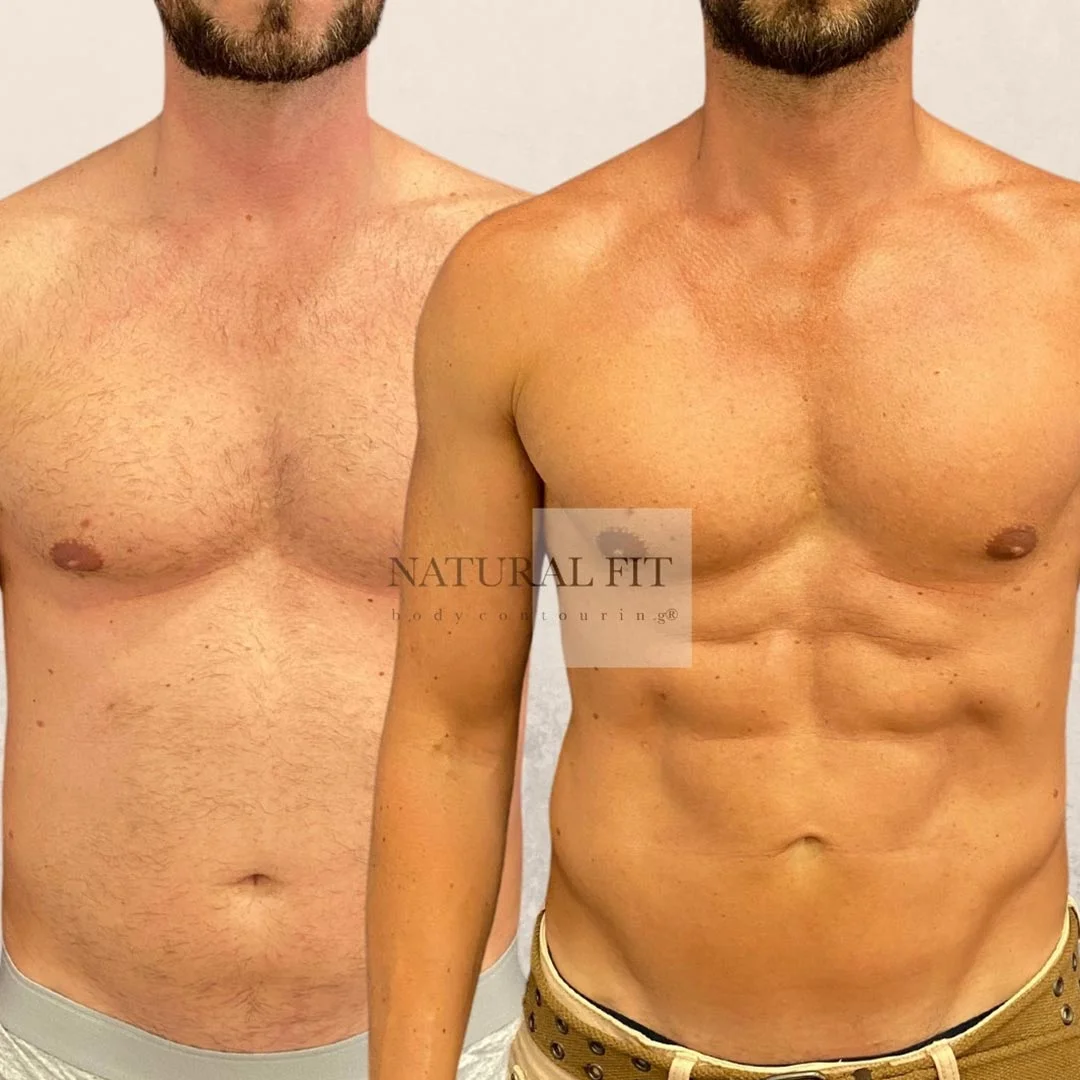 Antonio lipovaser HD resultado 2