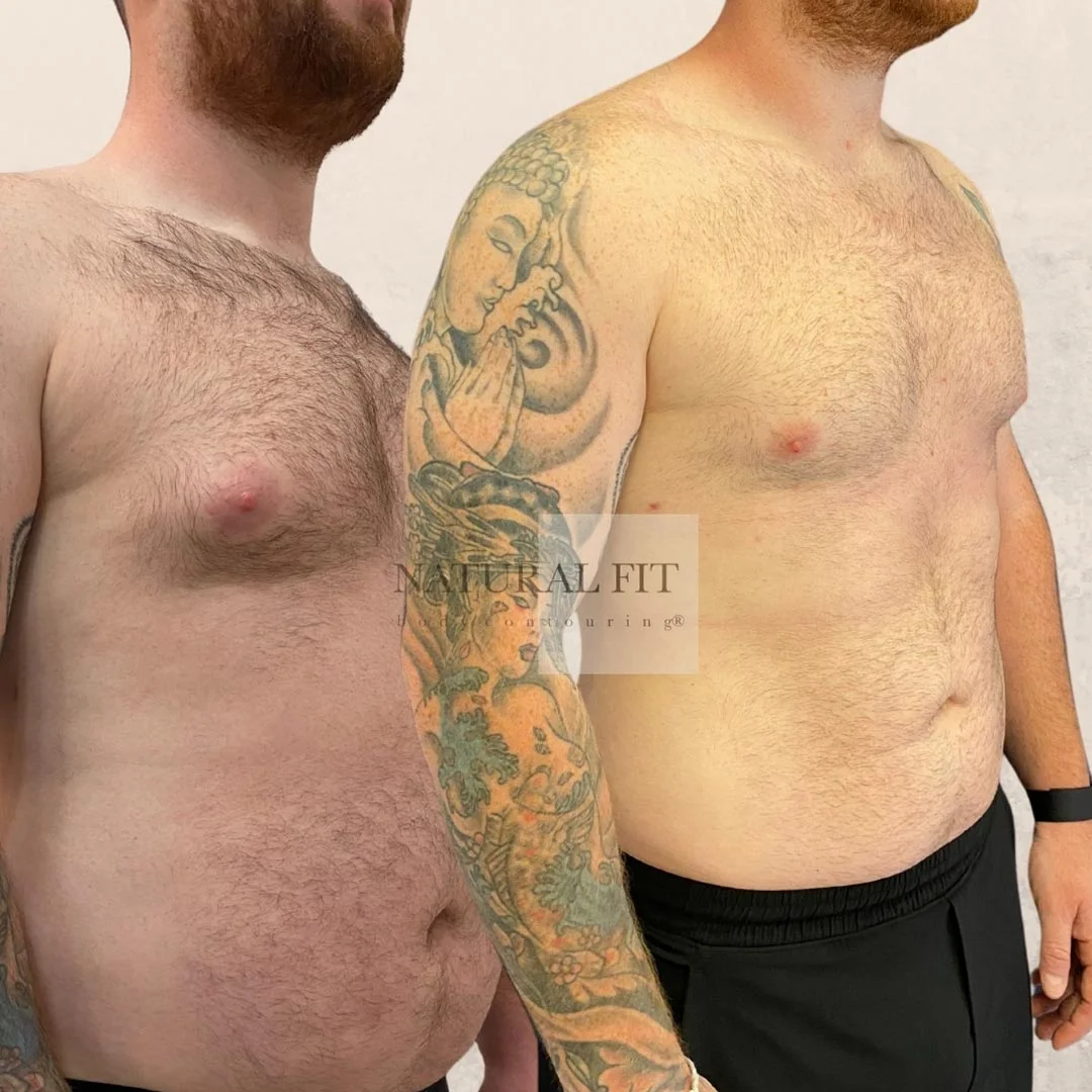 Miguel liposucción resultado 2