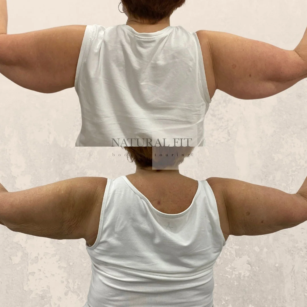 Despu&eacute;s Lipoescultura de Brazos — vista posterior