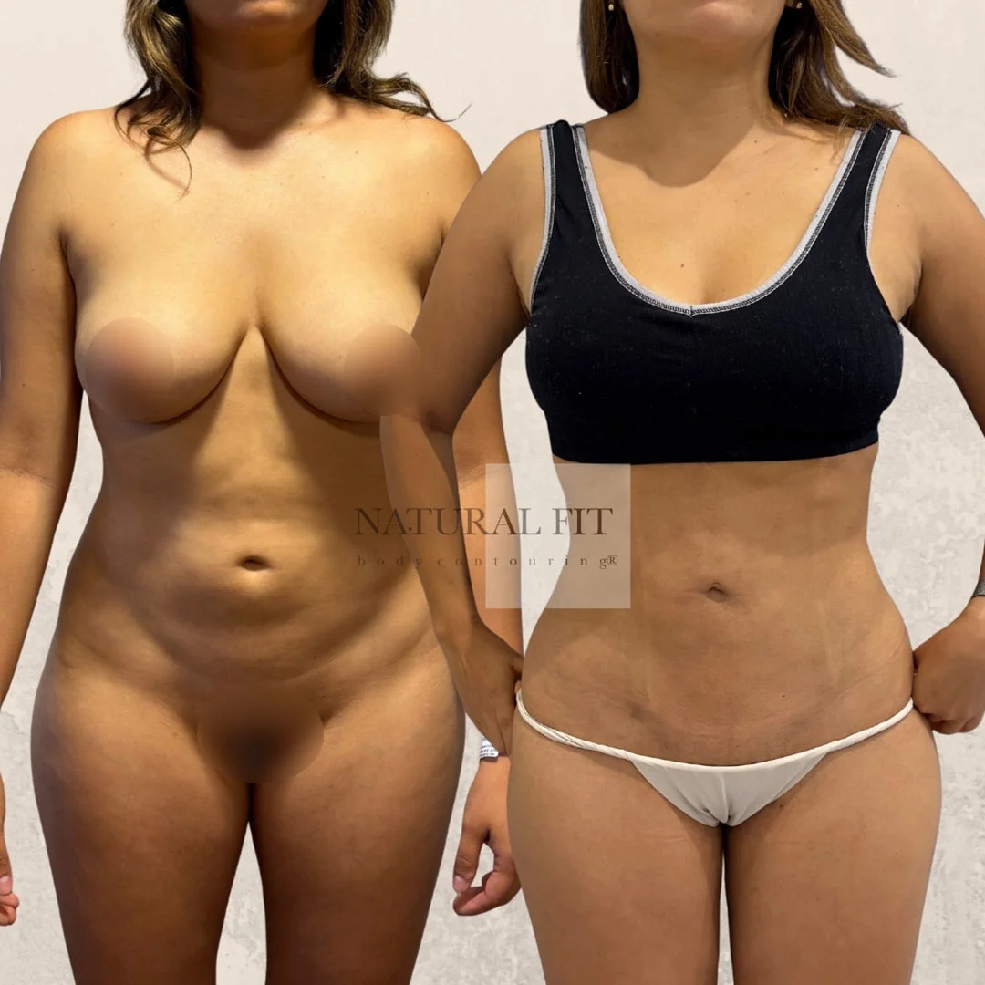 Antes y después lipoescultura corporal Barcelona - Caso 33