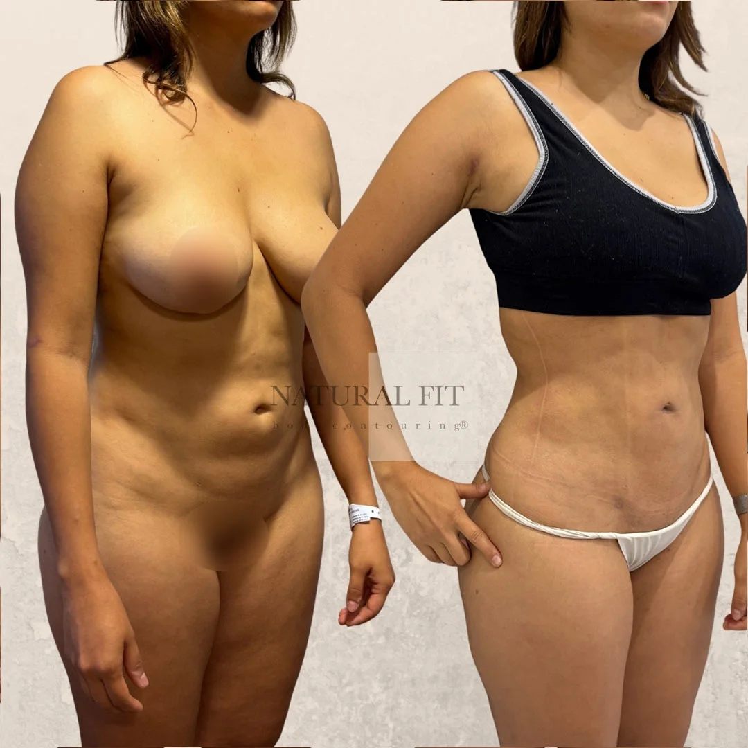 Antes y después lipoescultura corporal Barcelona - Caso 34