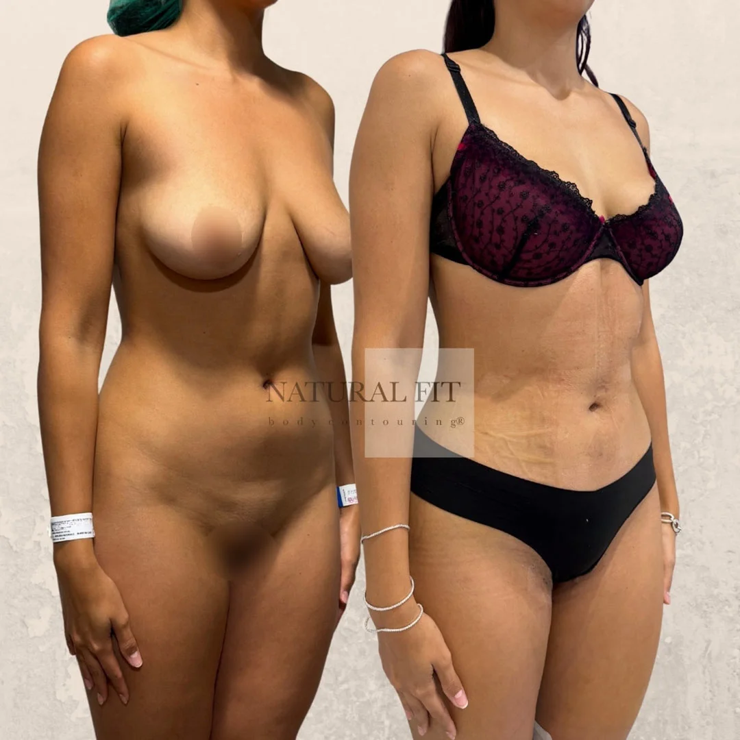 Antes y después lipoescultura corporal Barcelona - Caso 38