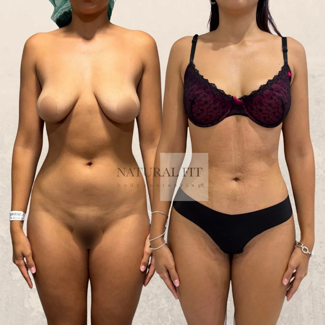 Antes y después lipoescultura corporal Barcelona - Caso 36