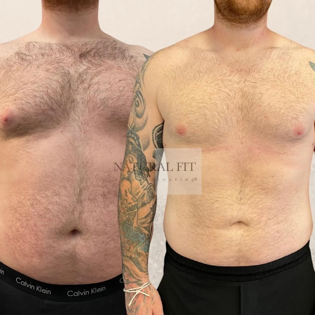 Antes y después liposucción mediana Miguel 33 años - NATURAL FIT Body Contouring® Barcelona