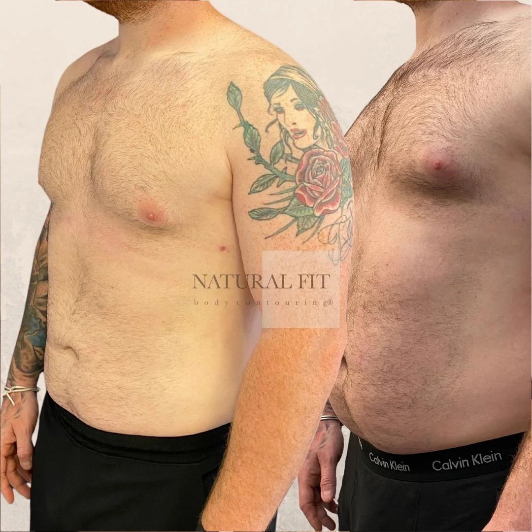 Miguel liposucción resultado 3