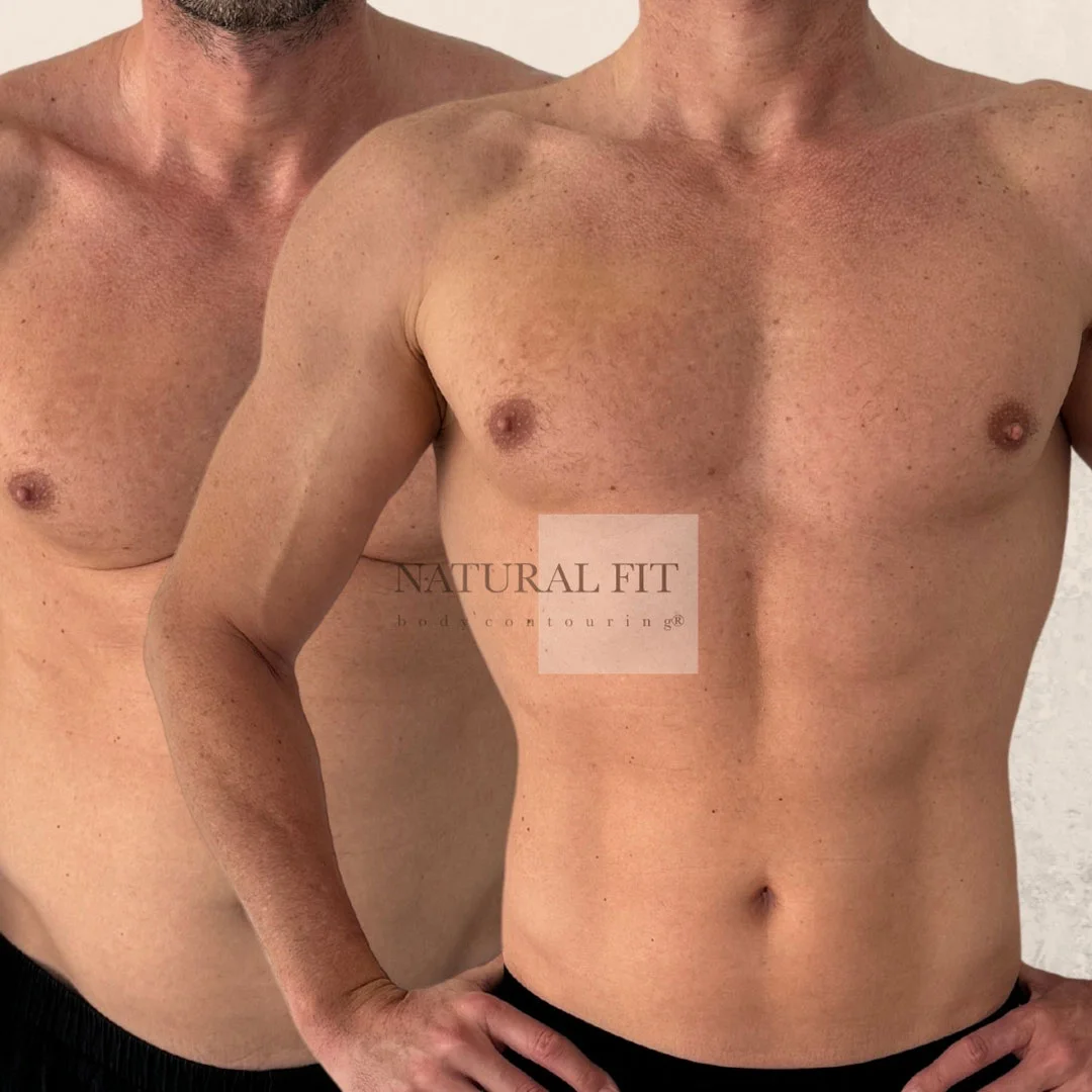 Resultado lipovaser 3D alta definición Sergio, 40 años, Barcelona - Dr. Martín Gastón