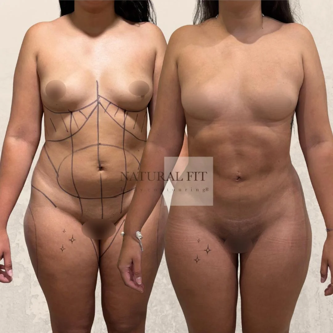 Resultado lipoescultura mid definition Marina, 22 años, Barcelona - Dr. Martín Gastón