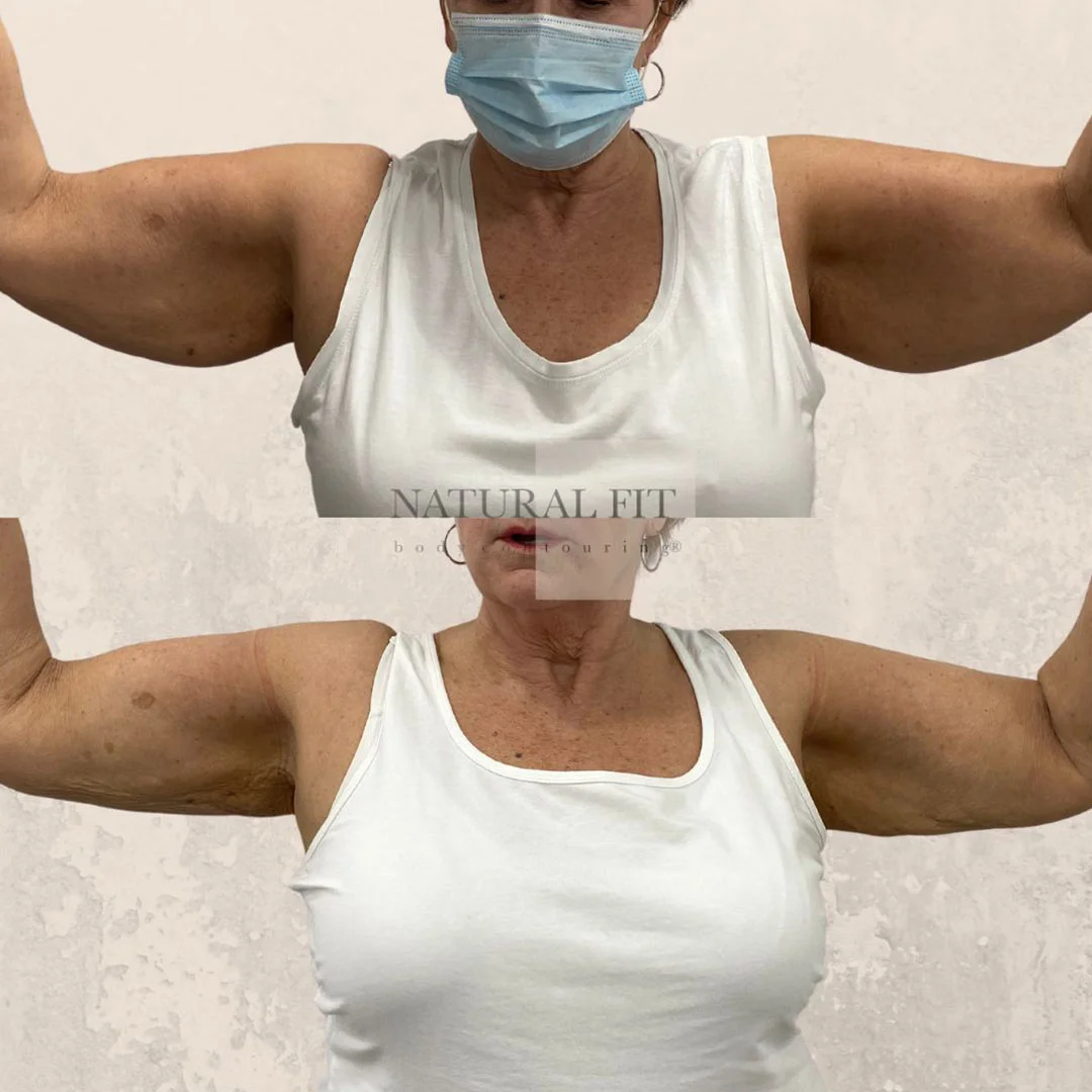 Despu&eacute;s Lipoescultura de Brazos