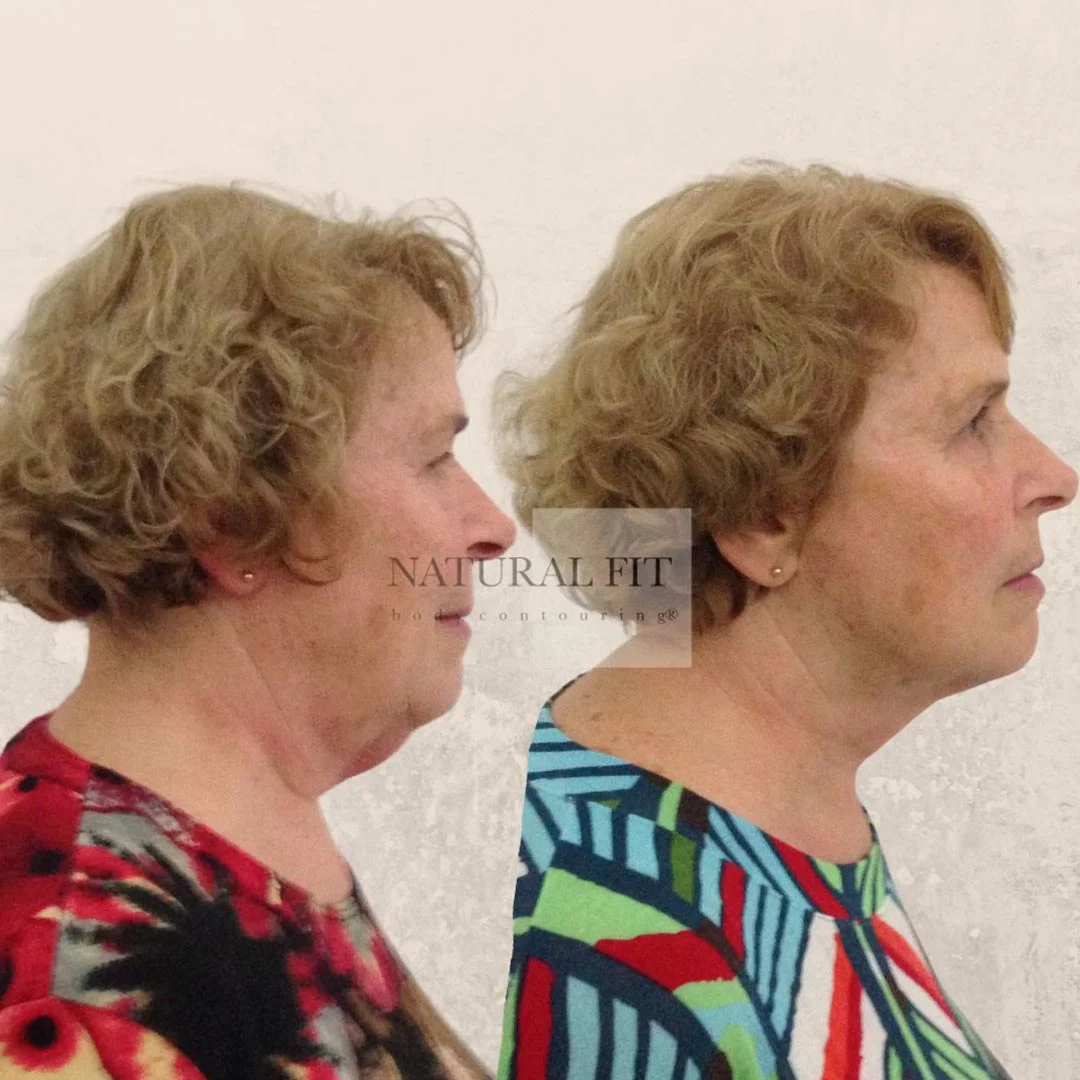 Resultado liposucción de papada Pilar, 69 años, Barcelona - Dr. Martín Gastón