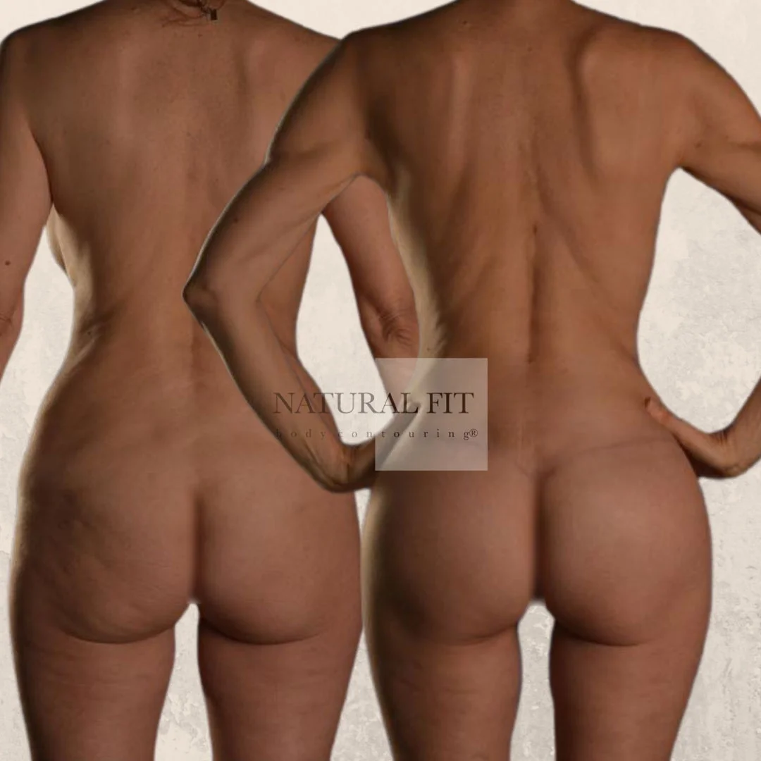 Despu&eacute;s Reducci&oacute;n Gl&uacute;tea