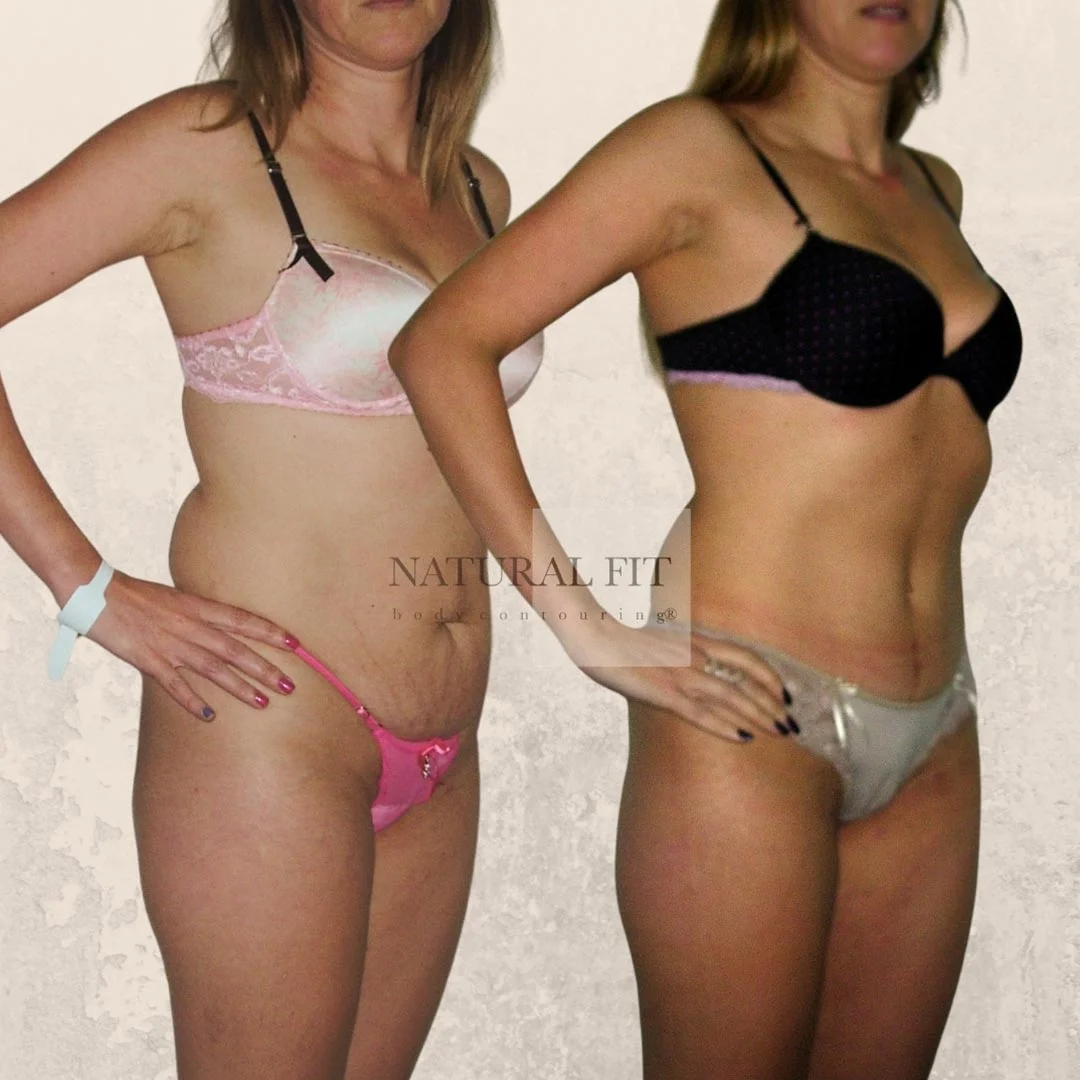 María dermolipectomía resultado 2