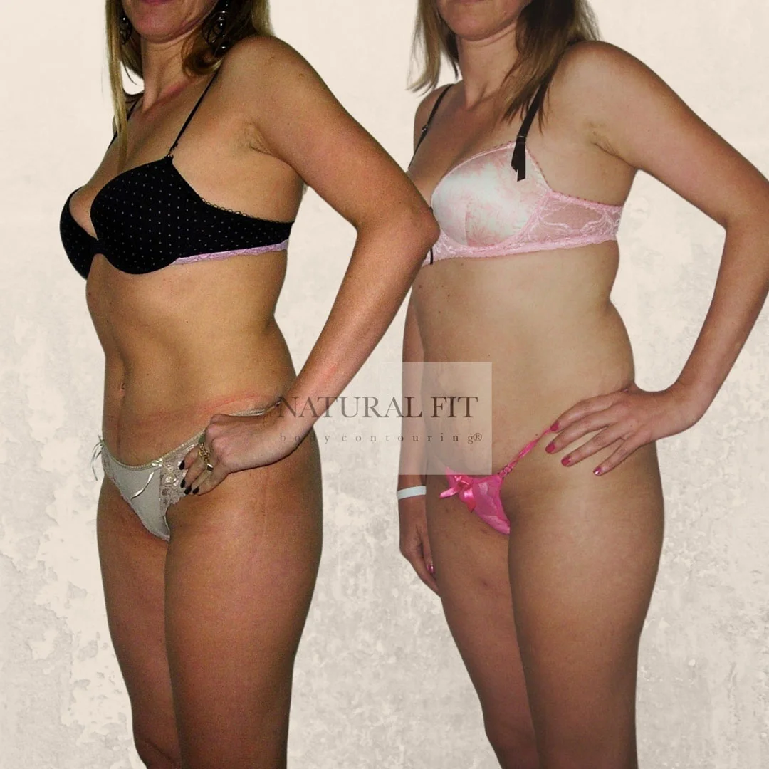 María dermolipectomía resultado 3