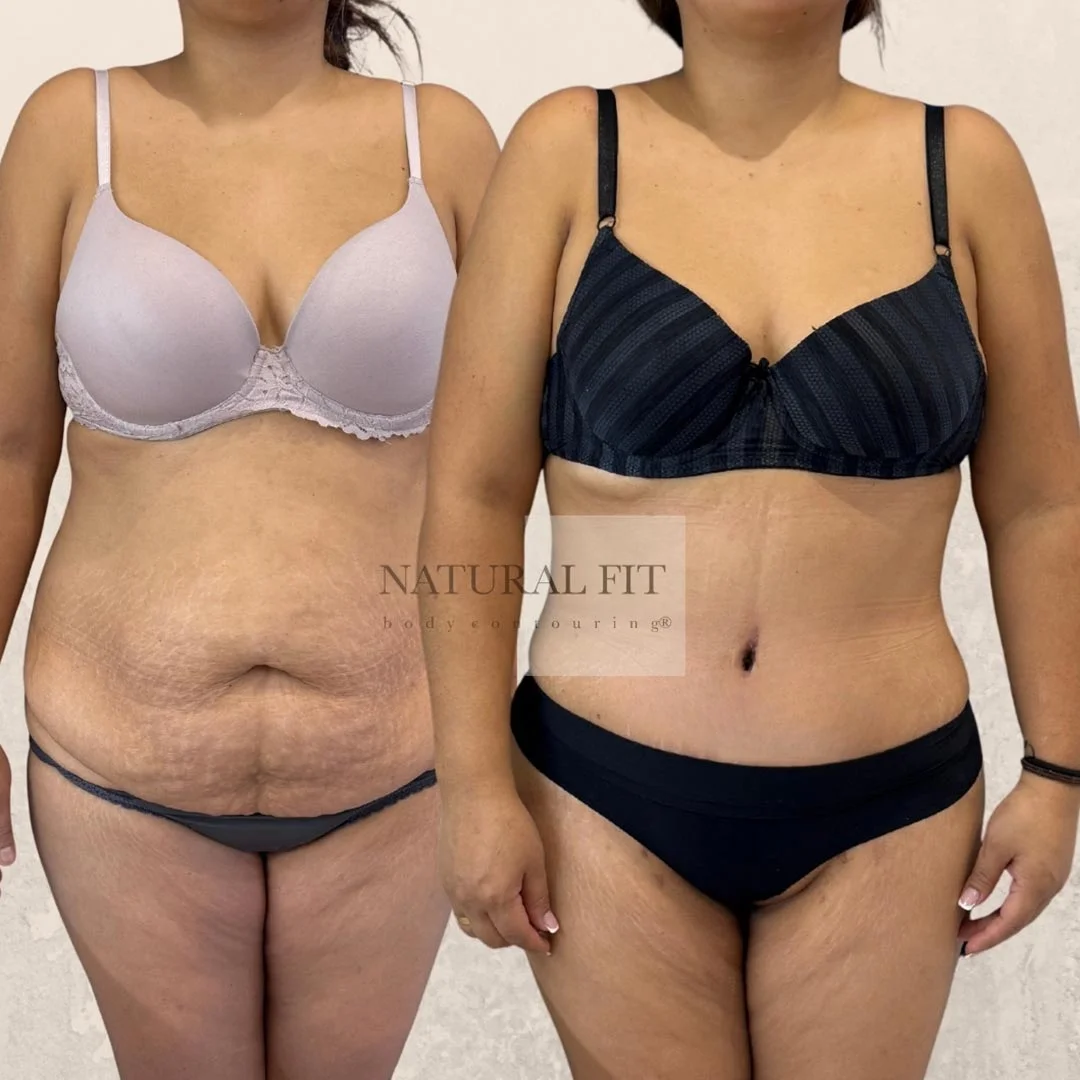 Resultado dermolipectomía abdominal Amanda, 34 años, Barcelona - Dr. Martín Gastón