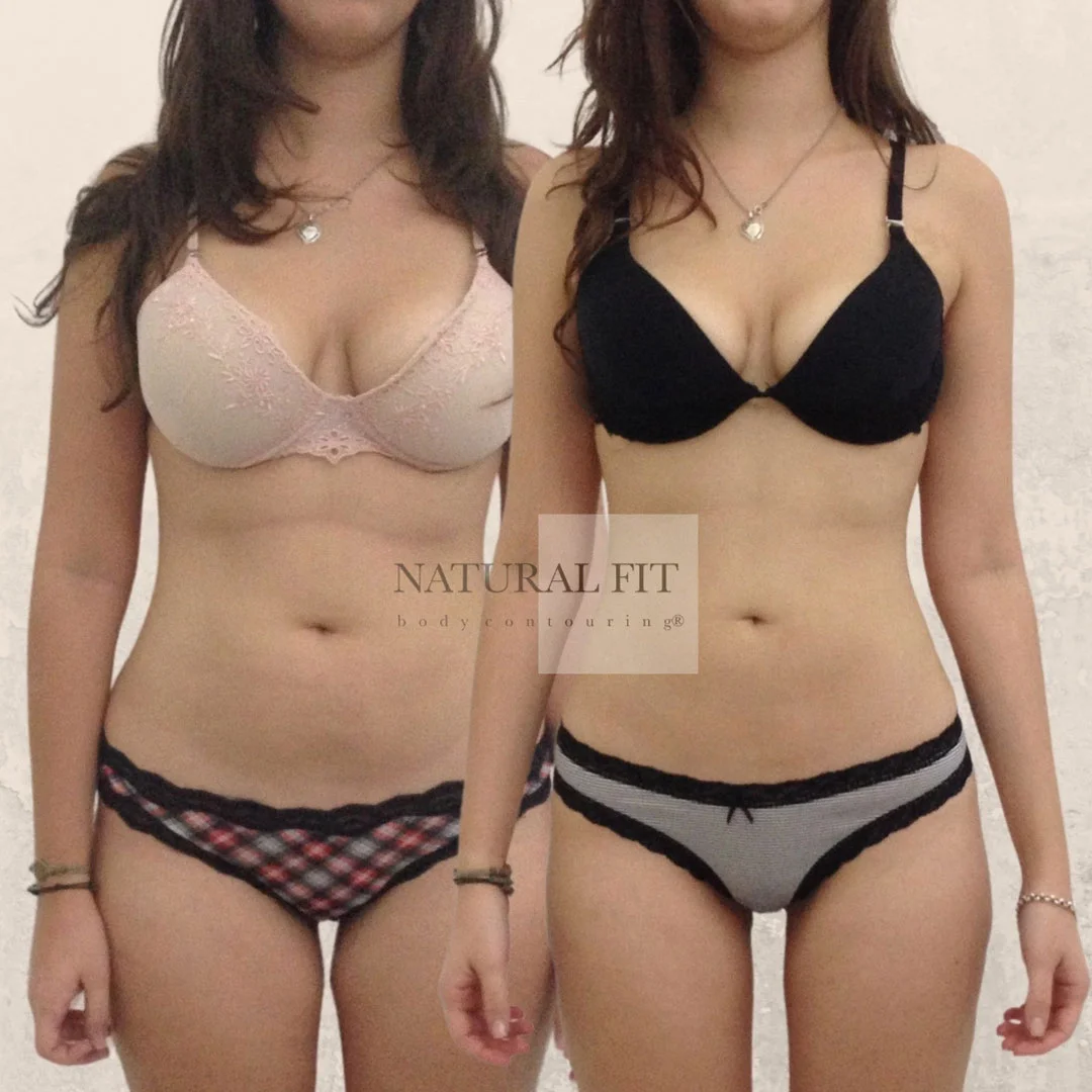 Antes y después lipovaser mid definition Laura 19 años - NATURAL FIT Body Contouring® Barcelona