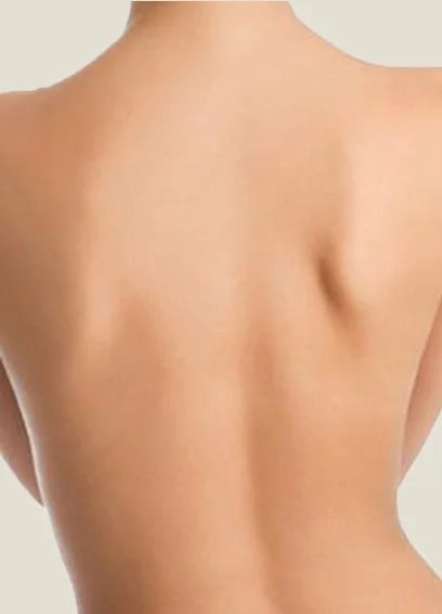 C&oacute;mo se realiza Lipoescultura de Espalda y Dorso