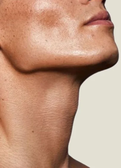 Neck and Jawline Liposculpture