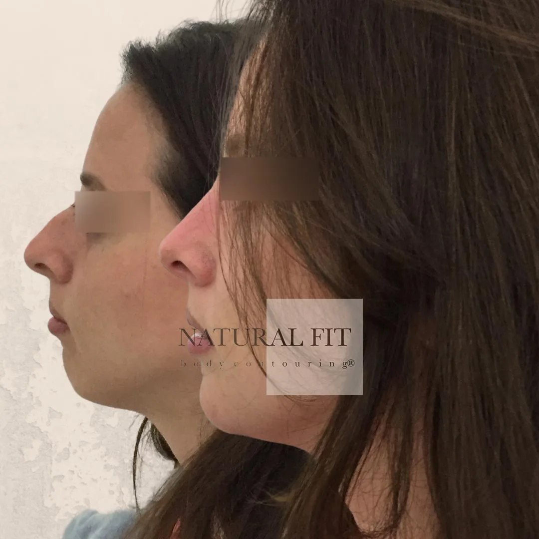 Resultado rinoplastia Laura Barcelona - Dr. Martín Gastón