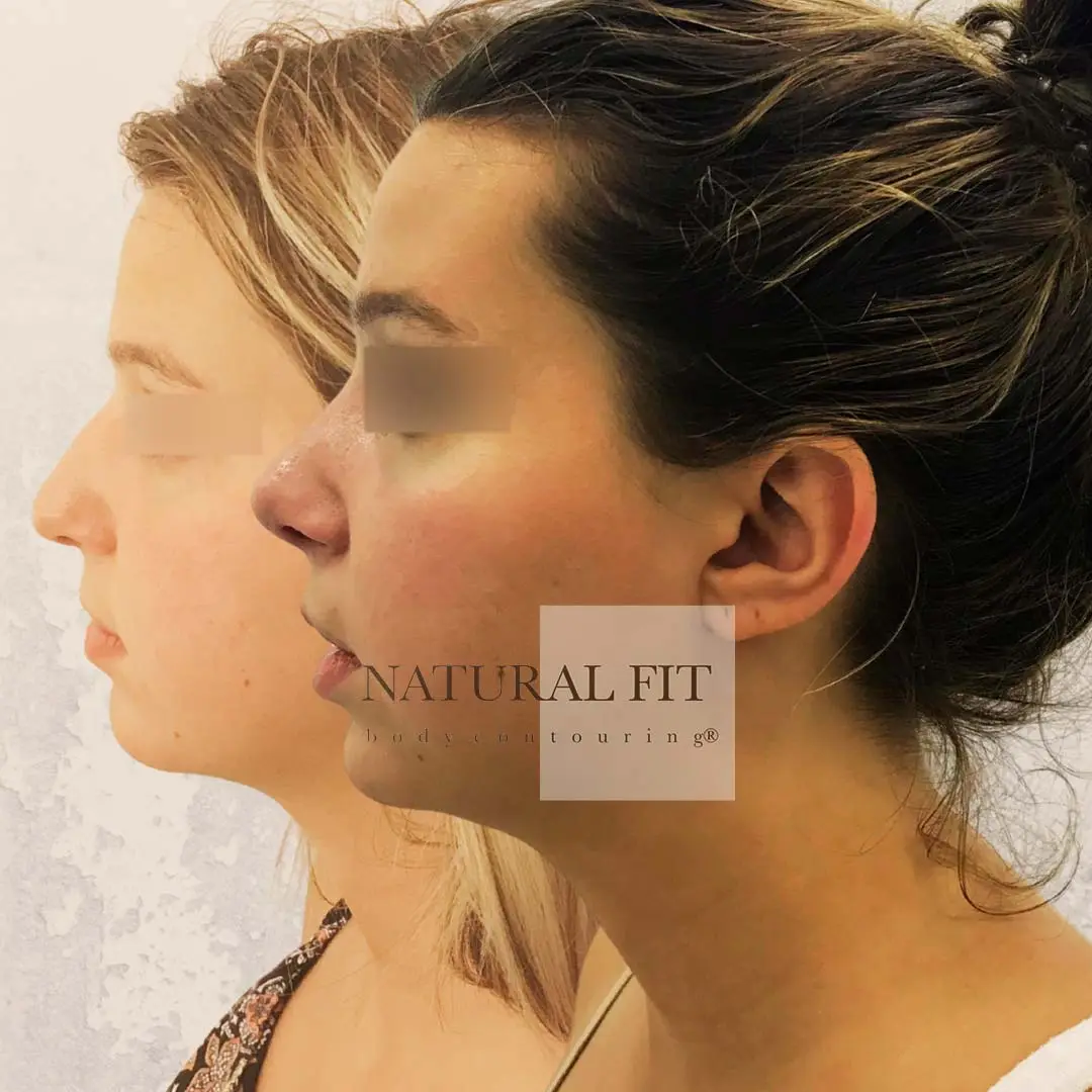 Resultado rinoplastia María Barcelona - Dr. Martín Gastón