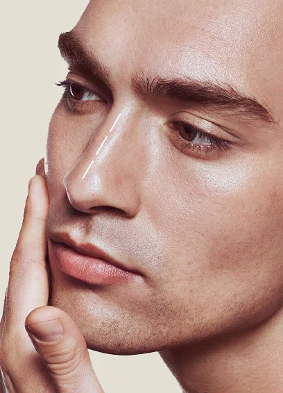 Resultado rinoplastia Ana Barcelona - Dr. Martín Gastón