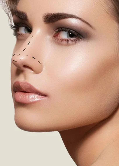 C&oacute;mo se realiza Rinoplastia